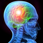 Seizures After Brain Injury
